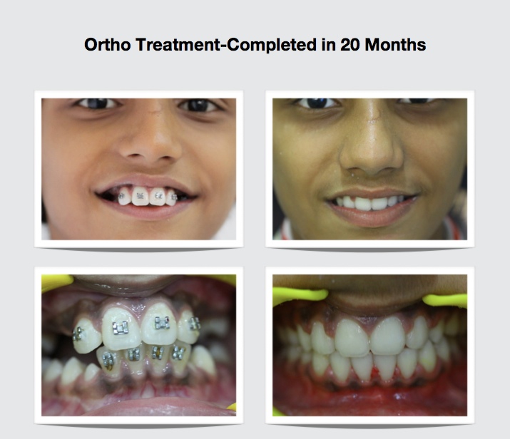 orthodontic treatment in mumbai- smile studio