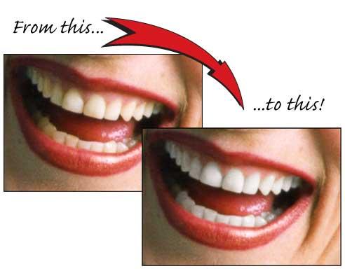teeth whitening treatment in mumbai- smile studio
