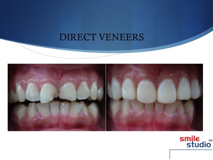 DENTAL VENEERS smile studio