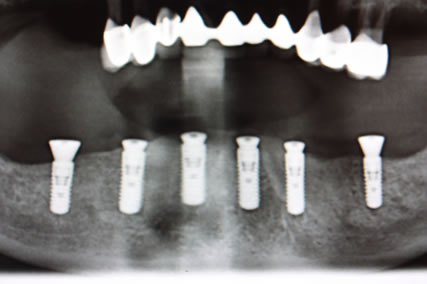 Implant With Framework- smile studio