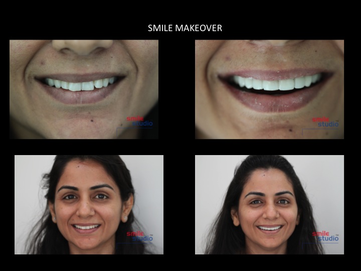 smile makeover treatment