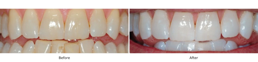 teeth whitening treatment mumbai - smile studio