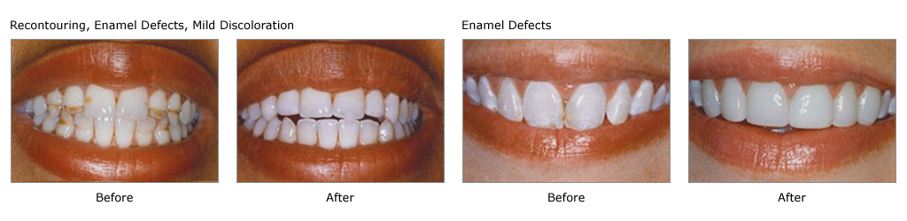 teeth whitening treatment mumbai - smile studio