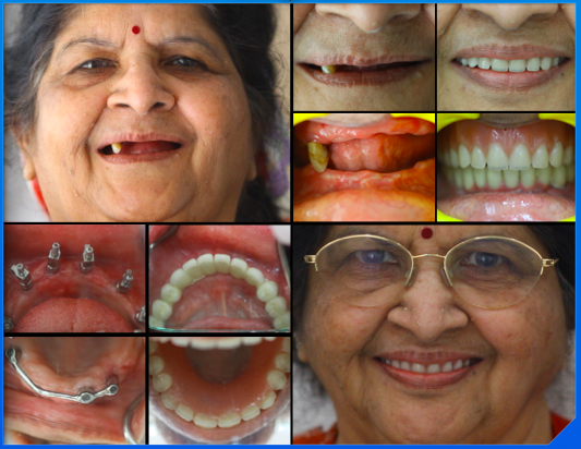 dental implant Full Mouth Reconstruction - SMILE DESIGN STUDIO