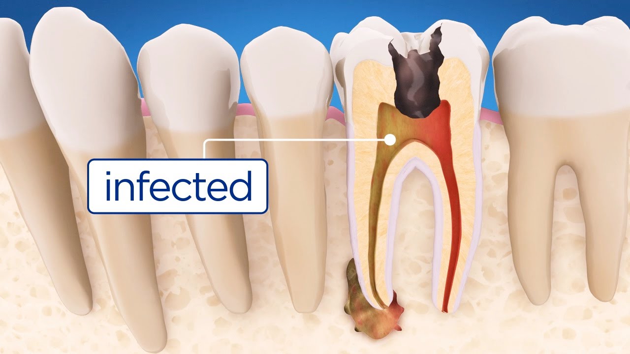 root canal treatment in Pune