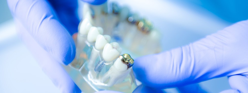 dental crown treatment