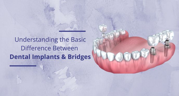Understanding the Basic difference between Dental Implants and bridges
